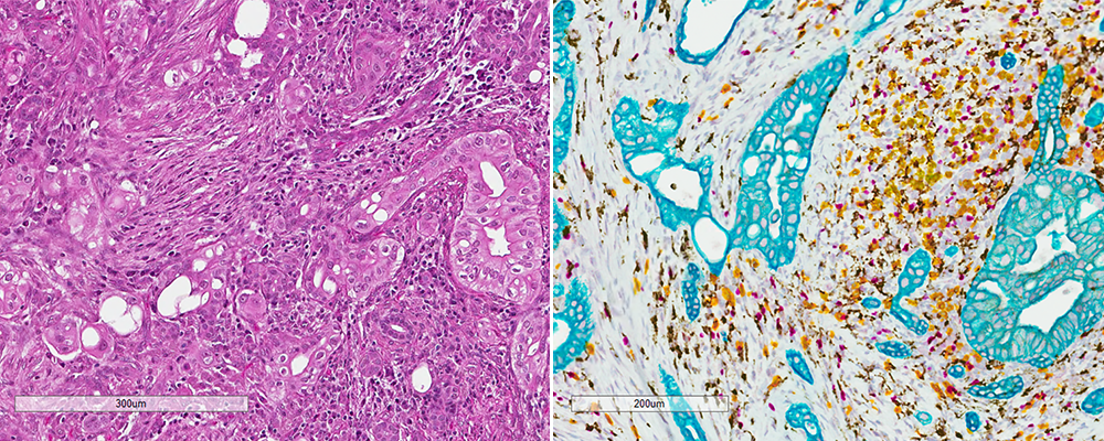 Two images displaying the same pancreatic ductal adenocarcinoma tissue. On the left is a standard H&E stain, showing the cell in pink. On the right is the advanced IHC stain, showing cells in purple, yellow, brown, and teal.